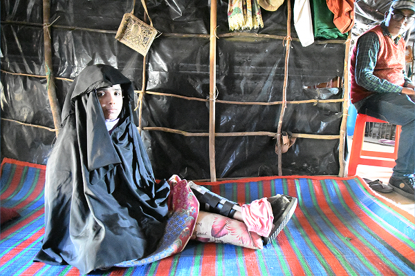 ミャンマー軍に撃たれたタツミンさんの左足は義足ではないかと思うほど細くて棒のようだった。＝28日、ロヒンギャ難民キャンプ　撮影：筆者＝